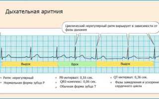 Что такое дыхательная аритмия и чем опасна для здоровья