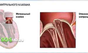 Чем опасен пролапс митрального клапана сердца для здоровья