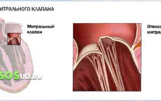 Чем опасен пролапс митрального клапана сердца для здоровья