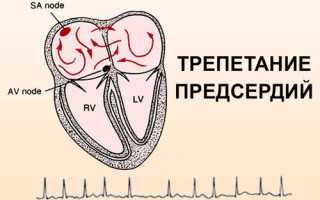 Что такое трепетание предсердий и чем опасно для здоровья