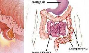 Симптомы и причины возникновения дивертикулеза кишечника