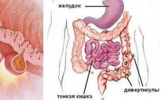 Симптомы и причины возникновения дивертикулеза кишечника