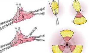 Что можно есть после операции геморроя: советы врачей