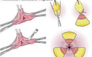 Что можно есть после операции геморроя: советы врачей