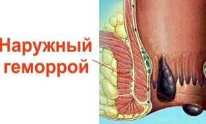 Что такое наружный геморрой и как его лечить?