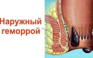 Что такое наружный геморрой и как его лечить?