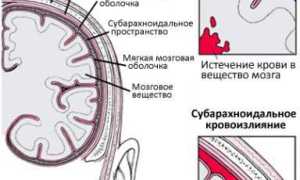 Субарахноидальное кровоизлияние: лечение, причины, симптомы и диагностика