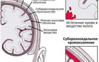 Субарахноидальное кровоизлияние: лечение, причины, симптомы и диагностика
