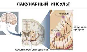 Что такое лакунарный ишемический инсульт и его причины: важные аспекты здоровья