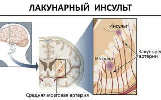 Что такое лакунарный ишемический инсульт и его причины: важные аспекты здоровья