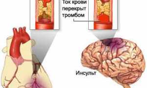 Причины и лечение атеросклероза сосудов головы: важные аспекты здоровья