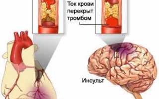 Причины и лечение атеросклероза сосудов головы: важные аспекты здоровья