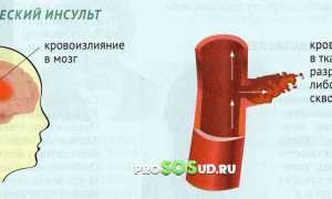 Геморрагический инсульт: симптомы, лечение, первая помощь и профилактика