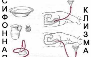 Зачем делают клизму перед операцией?
