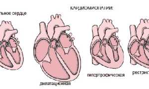 Кардиомиопатия с дилатацией полостей сердца: причины и лечение
