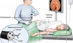 Симптомы и лечение эрозивного проктита
