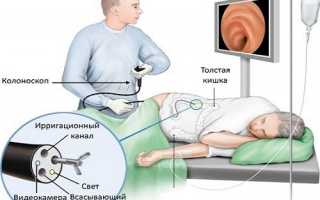 Симптомы и лечение эрозивного проктита