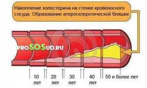 Облитерирующий атеросклероз ног: стадии, диагностика, профилактика и лечение заболеваний