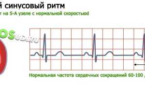Аритмия: классификация, причины, симптоматика, диагностика и лечение заболеваний сердца