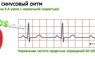 Аритмия: классификация, причины, симптоматика, диагностика и лечение заболеваний сердца