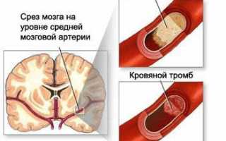Ишемическая болезнь головного мозга: причины и лечение