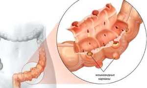 Код по МКБ-10 дивертикулеза кишечника