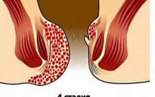 Симптомы и лечение запущенного геморроя четвертой степени