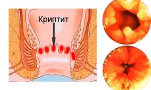 Заболевание криптит: что это, каковые его симптомы и причины появления?