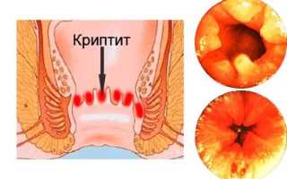 Заболевание криптит: что это, каковые его симптомы и причины появления?