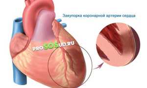 Инфаркт миокарда: как избежать, кто рискует больше всех и что делать