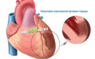Инфаркт миокарда: как избежать, кто рискует больше всех и что делать