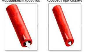 Лечение и причины ангиоспазмов: важные аспекты здоровья