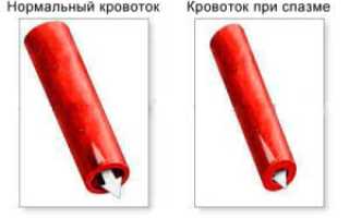 Лечение и причины ангиоспазмов: важные аспекты здоровья
