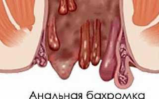 Что такое анальные бахромки и нужно ли их удалять?