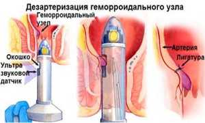 Виды дезартеризации геморроидальных узлов