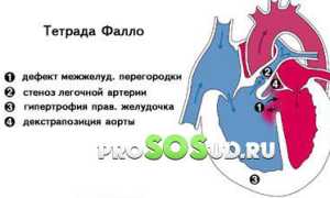 Тетрада фалло: проявления, операция, прогнозы и лечение