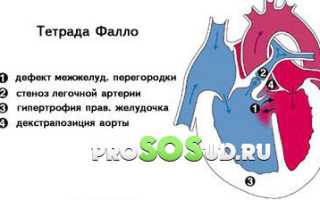 Тетрада фалло: проявления, операция, прогнозы и лечение