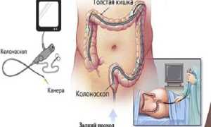 Основные принципы диеты после процедуры колоноскопии кишечника