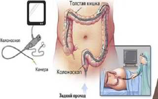 Основные принципы диеты после процедуры колоноскопии кишечника