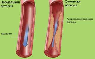 Чистка сосудов в домашних условиях для здоровья