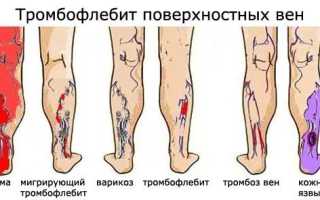 Чем опасен тромбофлебит во время беременности для здоровья