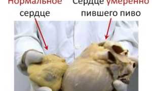 Что такое алкогольная кардиомиопатия и её последствия
