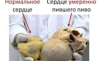 Что такое алкогольная кардиомиопатия и её последствия