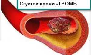 Симптомы тромба в сердце и лечение для здоровья