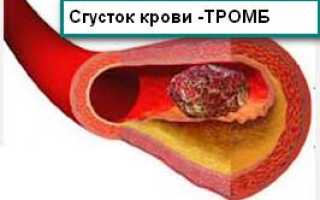 Симптомы тромба в сердце и лечение для здоровья