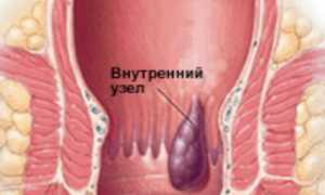 Лечение геморроя народными средствами в домашних условиях