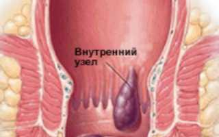 Лечение геморроя народными средствами в домашних условиях