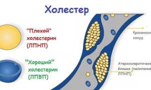 Что такое дислипидемия и её последствия для здоровья
