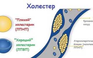 Что такое дислипидемия и её последствия для здоровья