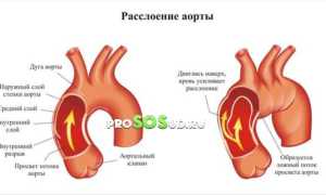 Расслоение аорты: клиническая картина, разновидности, диагностика и лечение заболеваний сердца